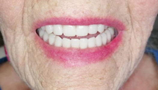After: the same patient smiling, wearing her new full upper and lower dentures.