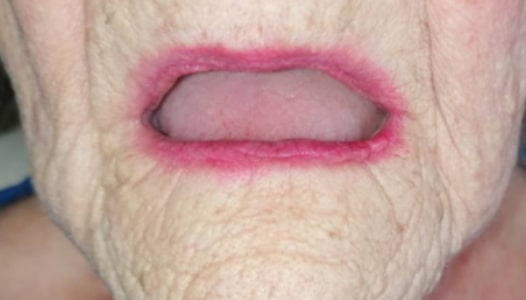 Before: an edentulous patient with no upper or lower teeth remaining.