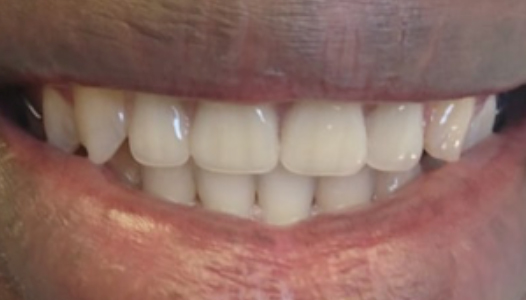 After: the same patient with a complete upper smile following an immediate denture.