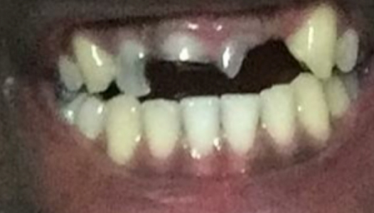 Before: a patient missing several upper front teeth.