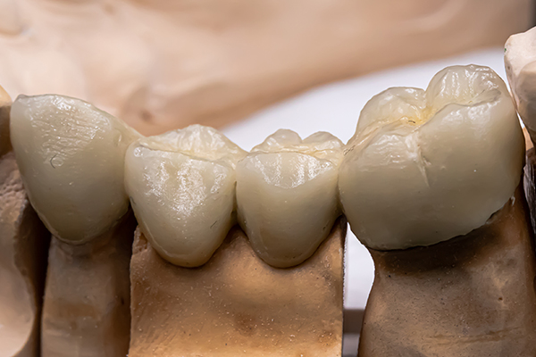 A finished zirconia bridge seated on its working dies on the bench at Inline Dental.