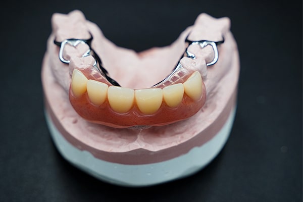 A cast chrome cobalt partial denture with precision clasps.